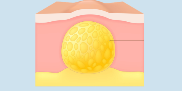 Was ist ein Lipödem?